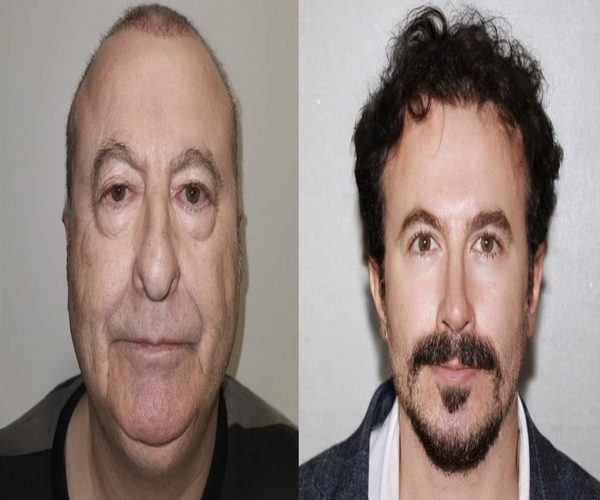 Turkish-doctor-who-gained-viral-fame-for-dramatic-face-surgeries-accused-of-using-fake-photos--lawsuit-filed-against-him
